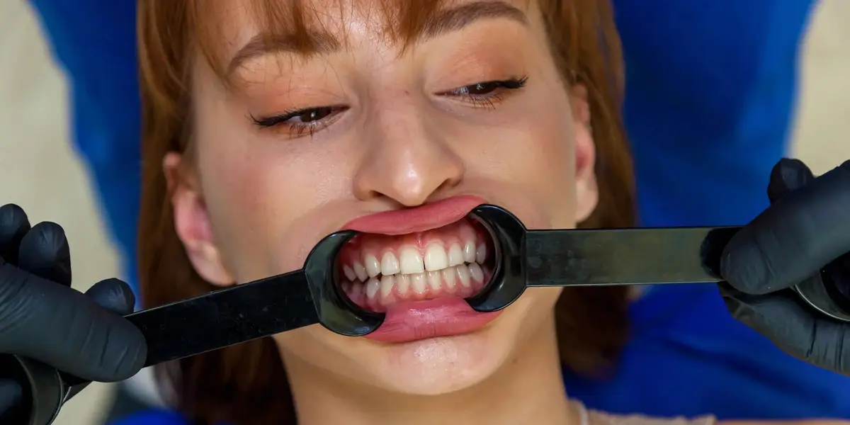 Dental Photography Cheek Retractors