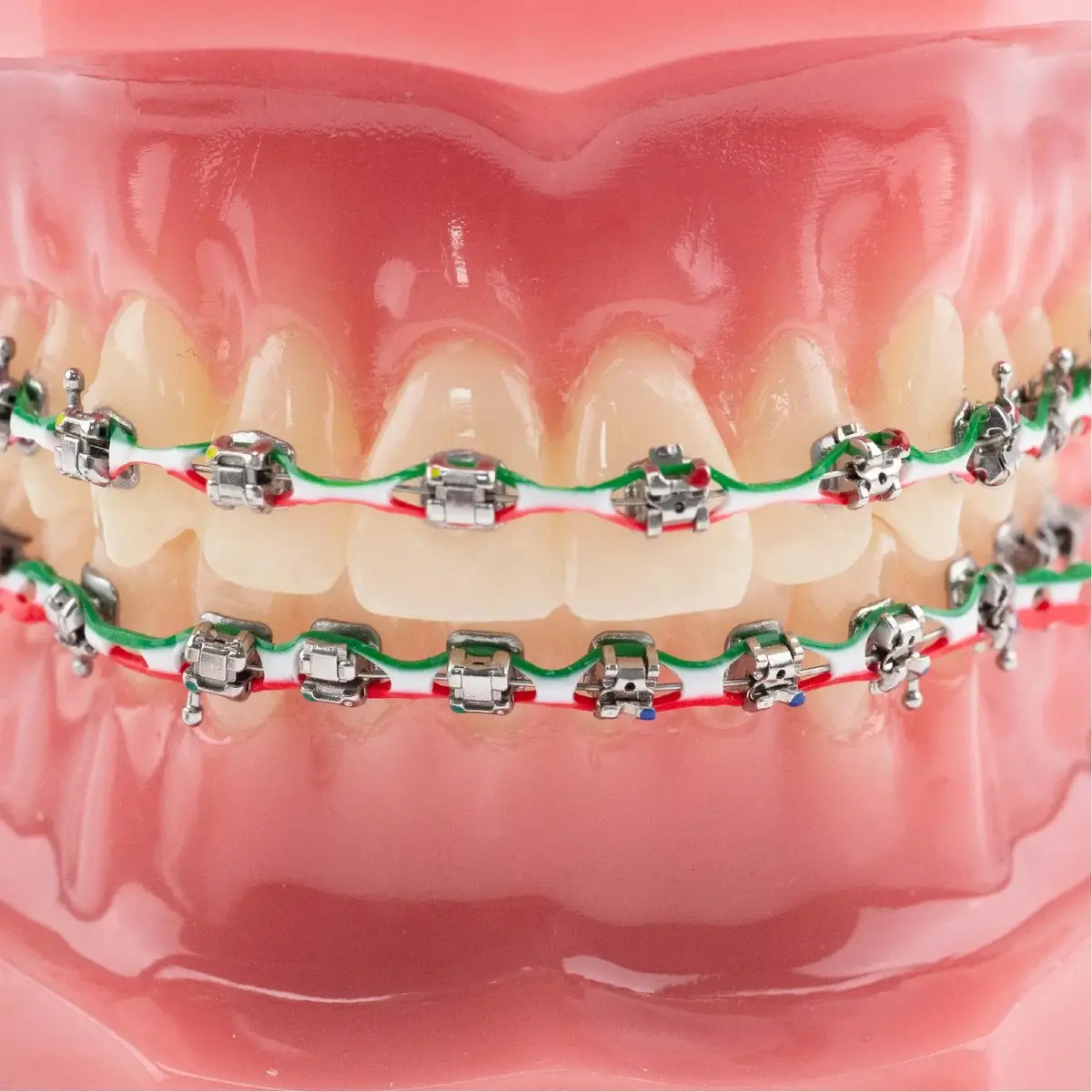 Power Chain Braces