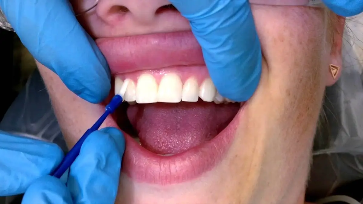 Fluoride Varnish