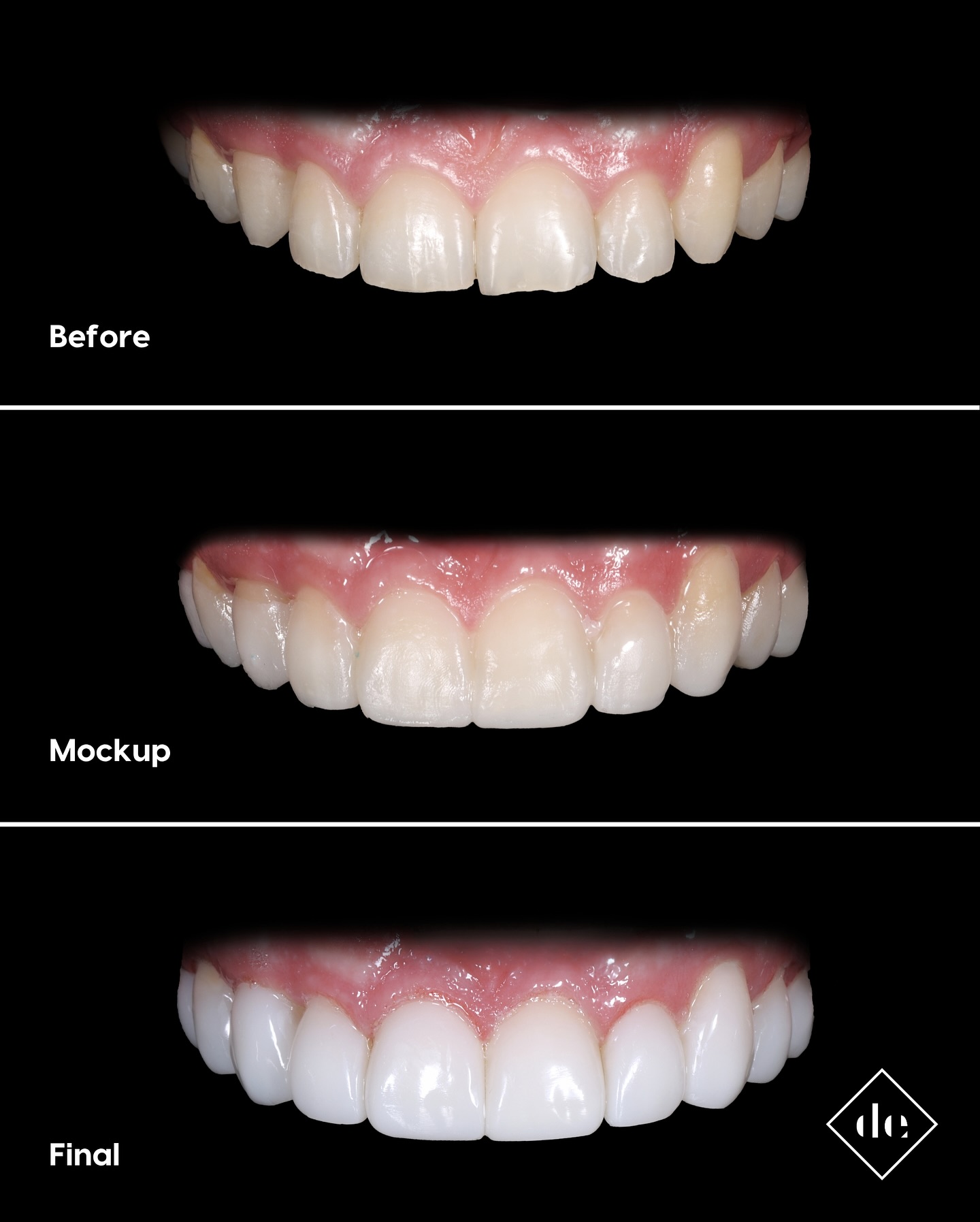 Digital Composite – Dental Restorations in Pakistan