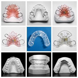 Dental Retainer for Post-Orthodontic Stability