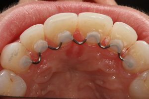 Fixed Lingual Retainer for Post-Orthodontic Tooth Stability